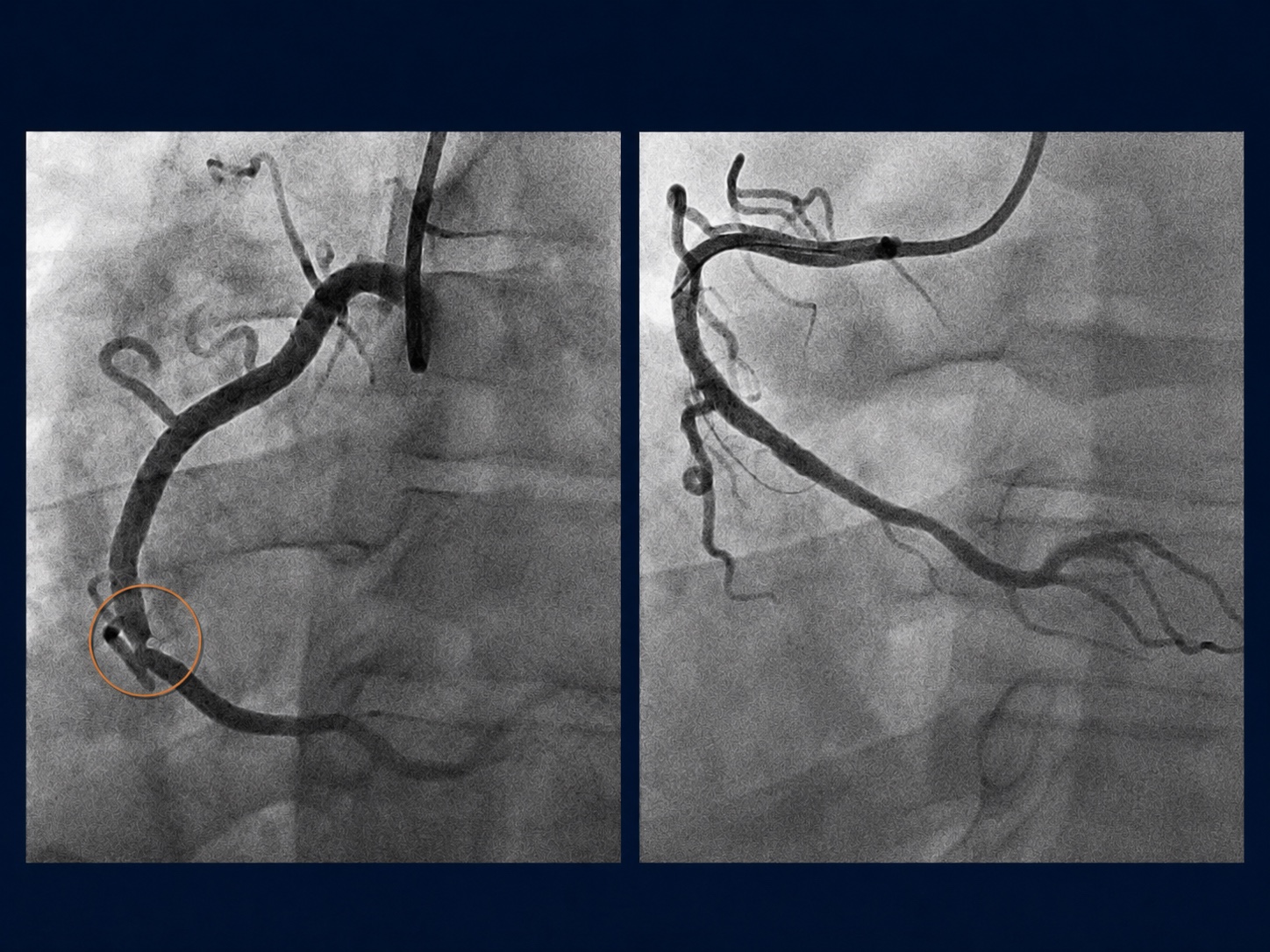Coronary angiogram before and after: a severe blockage choking blood flow (left), and the same artery after a wire-mesh stent restores it (right).